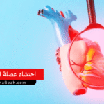 احتشاء عضلة القلب