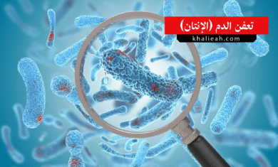 تعفن الدم (الإنتان)