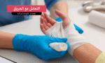 التعامل مع الحروق