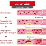 تصلب الشرايين