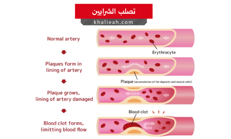 تصلب الشرايين