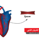 تشنج الشريان التاجي