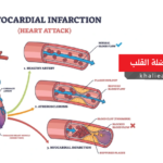 احتشاء عضلة القلب