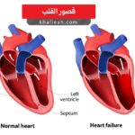 قصور القلب