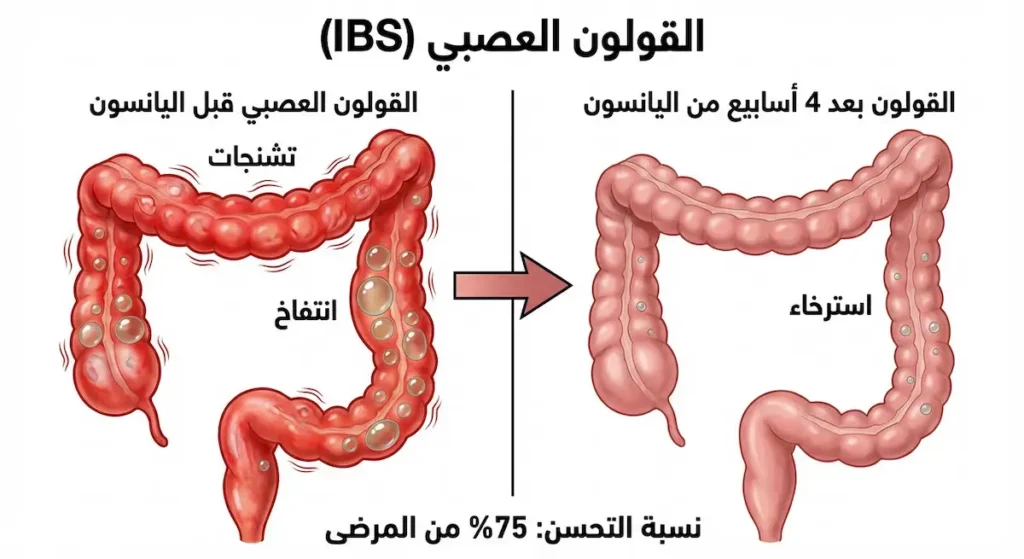 رسم توضيحي يُقارن حالة القولون العصبي قبل وبعد استخدام اليانسون لمدة 4 أسابيع مع نسبة تحسن 75%