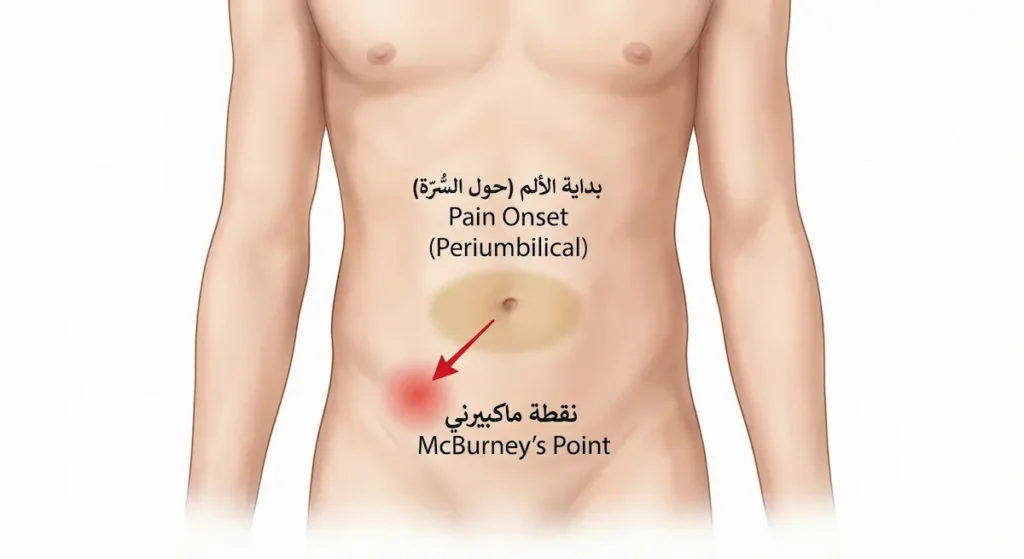 رسم توضيحي يُظهر انتقال ألم التهاب الزائدة الدودية من محيط السُّرّة إلى نقطة ماكبيرني في الربع السفلي الأيمن من البطن