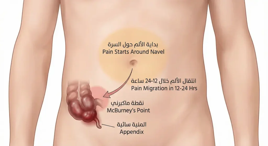 رسم توضيحي يُظهر مسار انتقال ألم التهاب الزائدة الدودية من السرة إلى نقطة ماكبرني في الربع السفلي الأيمن من البطن