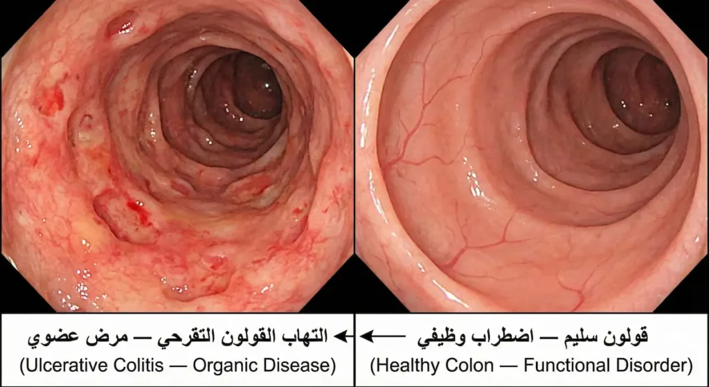 مقارنة بين صورة تنظيرية لبطانة قولون سليمة وردية وبطانة قولون ملتهبة بتقرحات تمثل التهاب القولون التقرحي