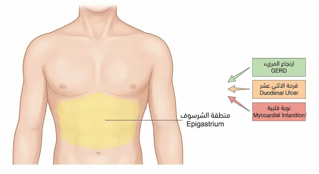 رسم توضيحي يُظهر منطقة فم المعدة مع ثلاثة أسباب محتملة للألم فيها تشمل ارتجاع المريء وقرحة الاثني عشر والنوبة القلبية