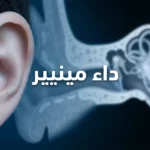 صورة غلاف توضيحية لمقالة عن داء مينيير تُظهر أذناً بشرية مع إسقاط ضبابي لتشريح الأذن الداخلية والقوقعة والقنوات الهلالية على خلفية طبية زرقاء داكنة