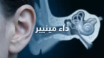 صورة غلاف توضيحية لمقالة عن داء مينيير تُظهر أذناً بشرية مع إسقاط ضبابي لتشريح الأذن الداخلية والقوقعة والقنوات الهلالية على خلفية طبية زرقاء داكنة
