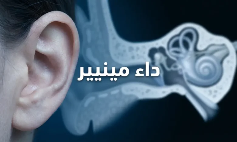 صورة غلاف توضيحية لمقالة عن داء مينيير تُظهر أذناً بشرية مع إسقاط ضبابي لتشريح الأذن الداخلية والقوقعة والقنوات الهلالية على خلفية طبية زرقاء داكنة