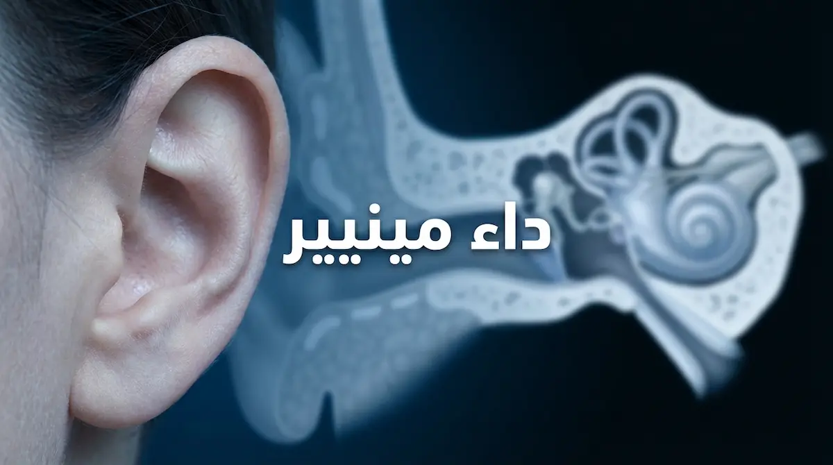 صورة غلاف توضيحية لمقالة عن داء مينيير تُظهر أذناً بشرية مع إسقاط ضبابي لتشريح الأذن الداخلية والقوقعة والقنوات الهلالية على خلفية طبية زرقاء داكنة