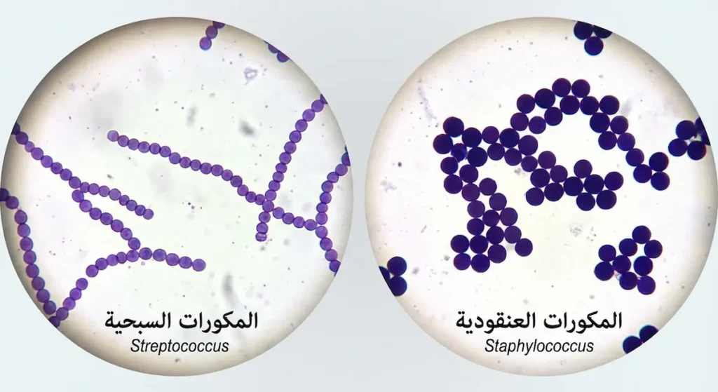 مقارنة تحت المجهر الضوئي بصبغة غرام تُظهر المكورات العنقودية متجمعة في عناقيد غير منتظمة على اليمين والمكورات السبحية مرتبة في سلاسل خطية على اليسار وكلاهما بلون بنفسجي داكن
