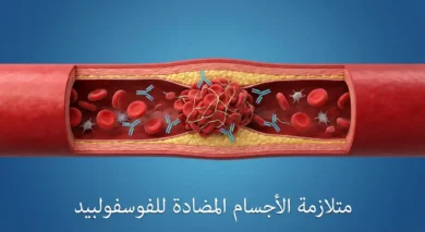 رسم توضيحي طبي يُظهر وعاءً دموياً مع تكوّن جلطة وأجسام مضادة تستهدف جداره، مع عنوان متلازمة الأجسام المضادة للفوسفولبيد