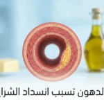 غلاف مقال طبي يُظهر مقطعاً عرضياً لشريان بشري مع لويحة دهنية جزئية وأطعمة متنوعة في الخلفية مع عنوان هل الدهون تسبب انسداد الشرايين