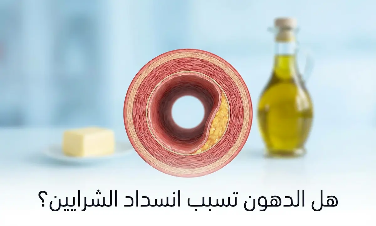 غلاف مقال طبي يُظهر مقطعاً عرضياً لشريان بشري مع لويحة دهنية جزئية وأطعمة متنوعة في الخلفية مع عنوان هل الدهون تسبب انسداد الشرايين