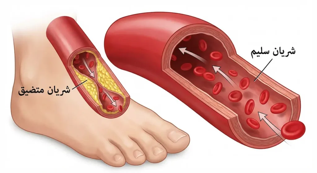 رسم توضيحي يقارن بين شريان سليم بتدفق دم طبيعي وشريان متضيق بترسبات دهنية في قدم مريض سكري