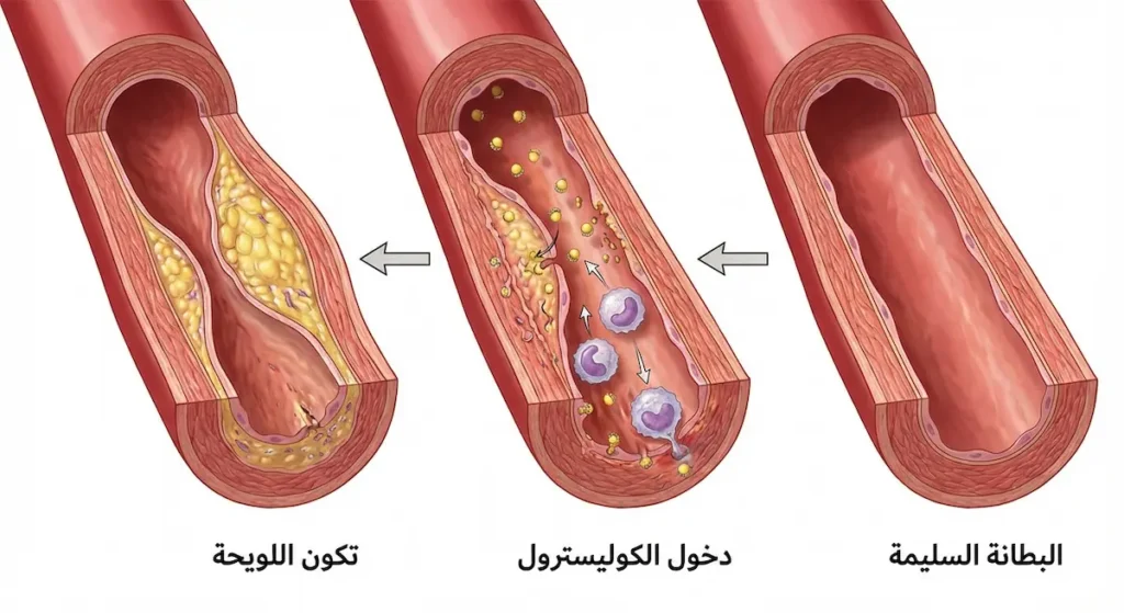 رسم تشريحي يوضح ثلاث مراحل لتكون اللويحة العصيدية من البطانة السليمة إلى دخول الكوليسترول ثم تكون اللويحة الكاملة