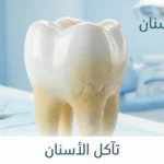 صورة غلاف تُظهر سناً بشرياً يوضح الفرق بين المينا السليمة اللامعة والمينا المتآكلة المصفرة مع كلمة تآكل الأسنان
