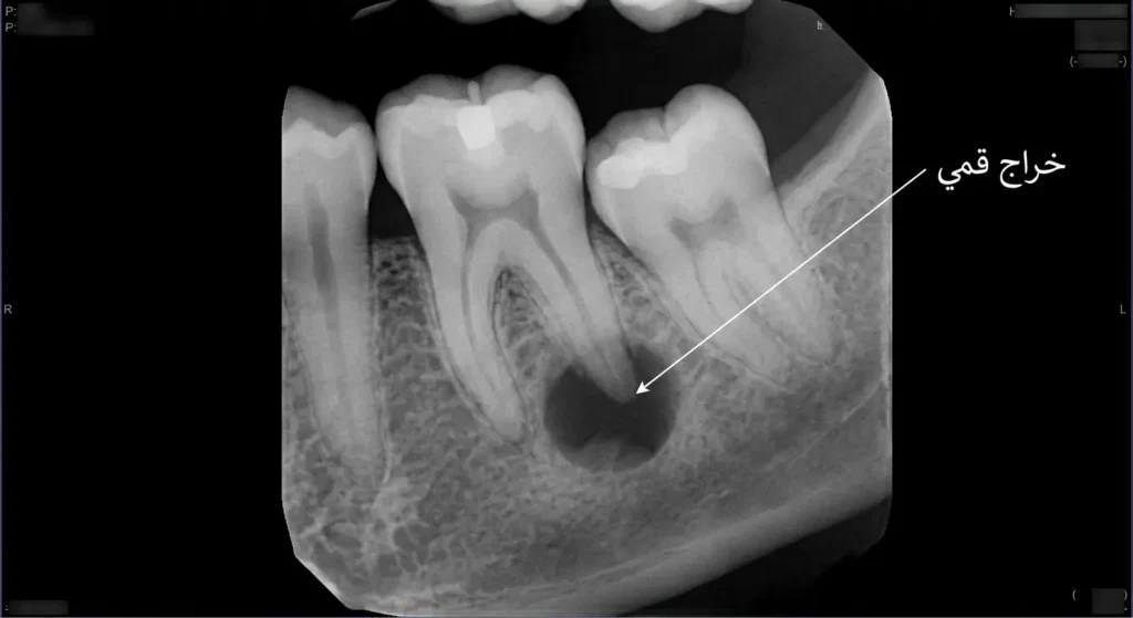 صورة أشعة سينية سنية تُظهر منطقة داكنة في قمة الجذر تدل على وجود خراج قمي