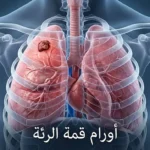 صورة تشريحية توضيحية لقمة الرئة تُظهر موقع ورم بانكوست مع عنوان المقال باللغة العربية