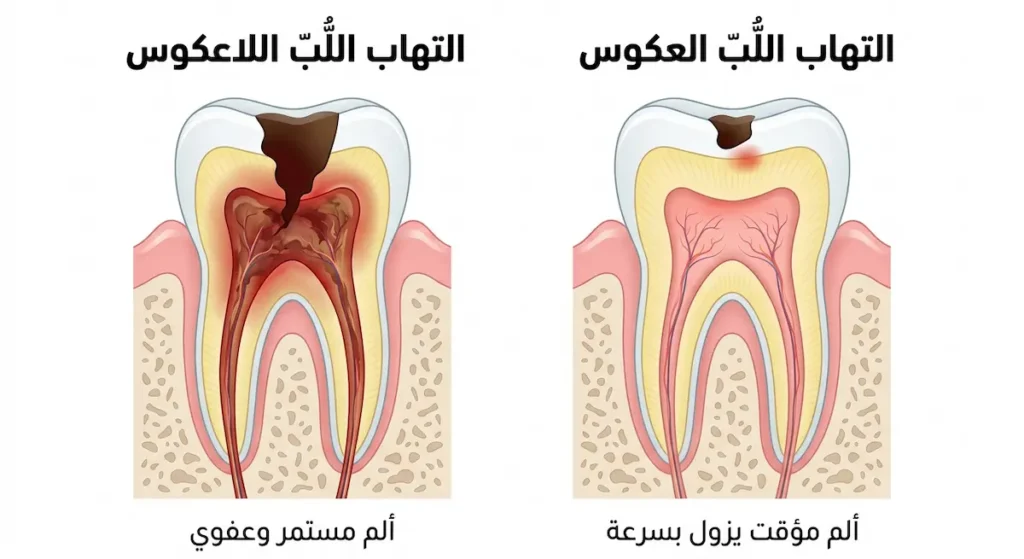 مقارنة توضيحية بين سنّ مصاب بالتهاب اللُّبّ العكوس القابل للشفاء وسنّ مصاب بالتهاب اللُّبّ اللاعكوس الذي يحتاج لعلاج جذور