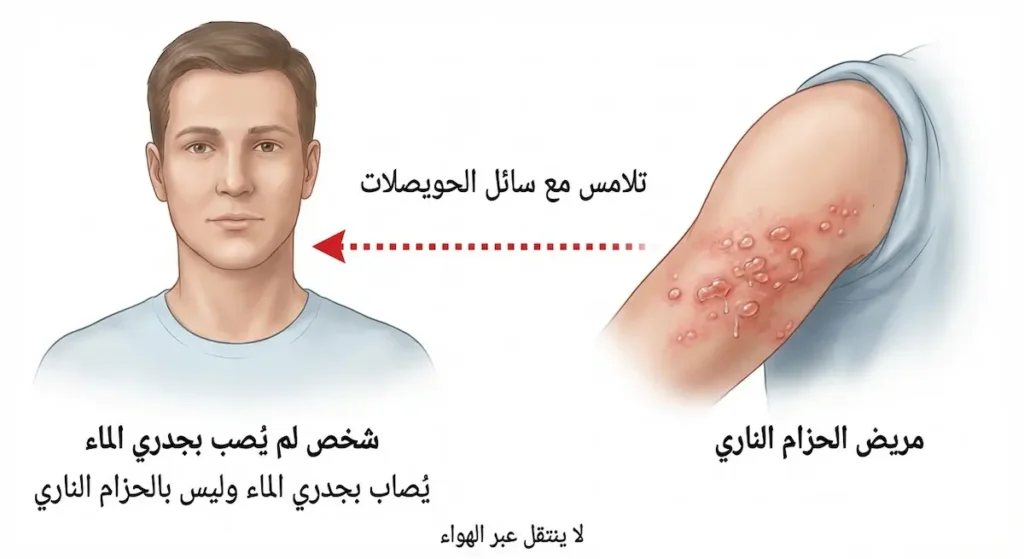 رسم توضيحي يبيّن أن فيروس الحزام الناري ينتقل بالتلامس المباشر مع سائل الحويصلات فقط ويسبب جدري الماء وليس الحزام الناري لدى الشخص غير المحصّن