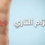 صورة غلاف توضح طفح الحزام الناري على جذع شخص بالغ مع عنوان المقال باللغة العربية