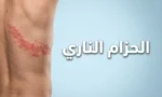 صورة غلاف توضح طفح الحزام الناري على جذع شخص بالغ مع عنوان المقال باللغة العربية
