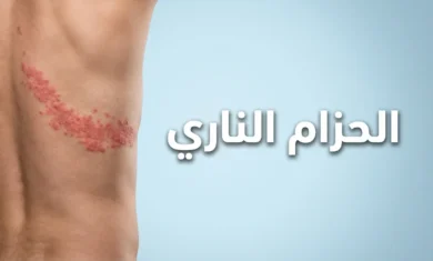 صورة غلاف توضح طفح الحزام الناري على جذع شخص بالغ مع عنوان المقال باللغة العربية