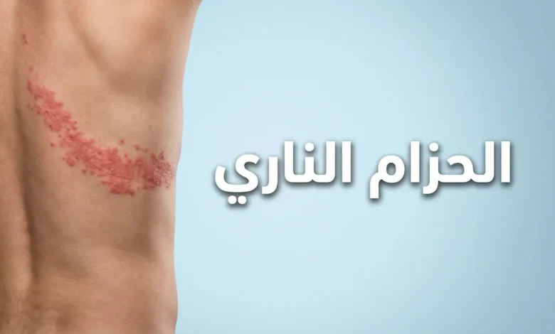صورة غلاف توضح طفح الحزام الناري على جذع شخص بالغ مع عنوان المقال باللغة العربية