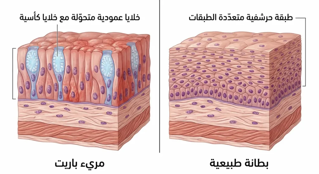 مقارنة مجهرية بين البطانة الطبيعية للمريء وبطانة مريء باريت المتحولة